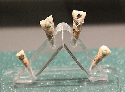 Glue Used by Ancient Maya Dentists to Affix Gems to Teeth Delivers Bonus Benefit